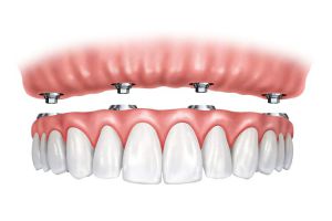 Only four implants per jaw are required for the All-on-4 treatment concept